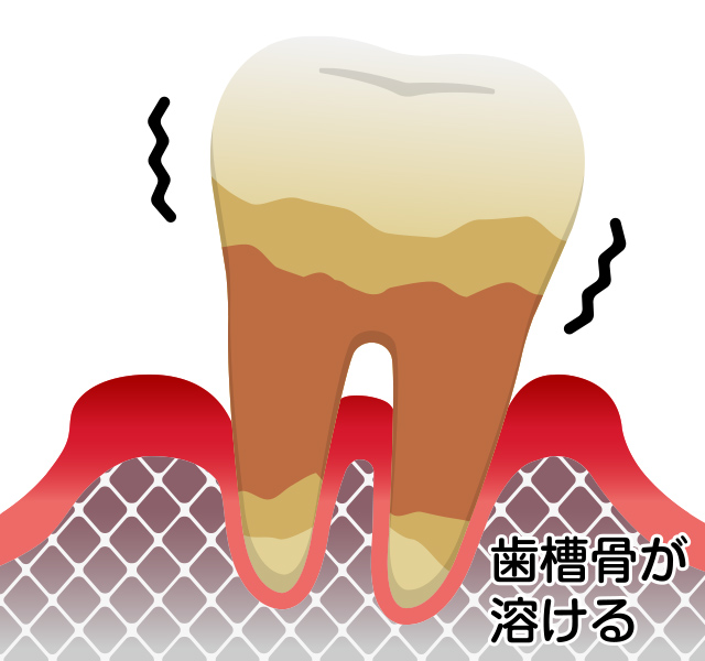重度歯周病