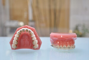 主な歯列矯正